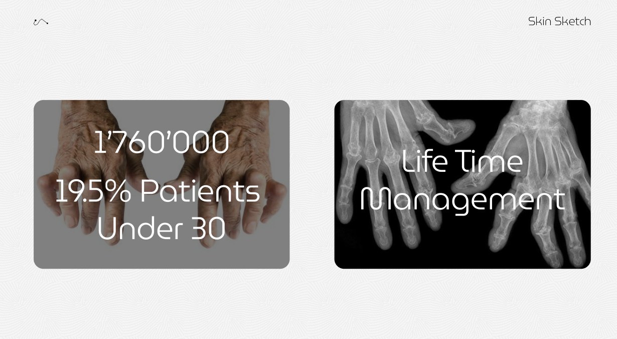 1,760,000 hand osteoarthritis patients, 19.5% under 30 – lifetime management